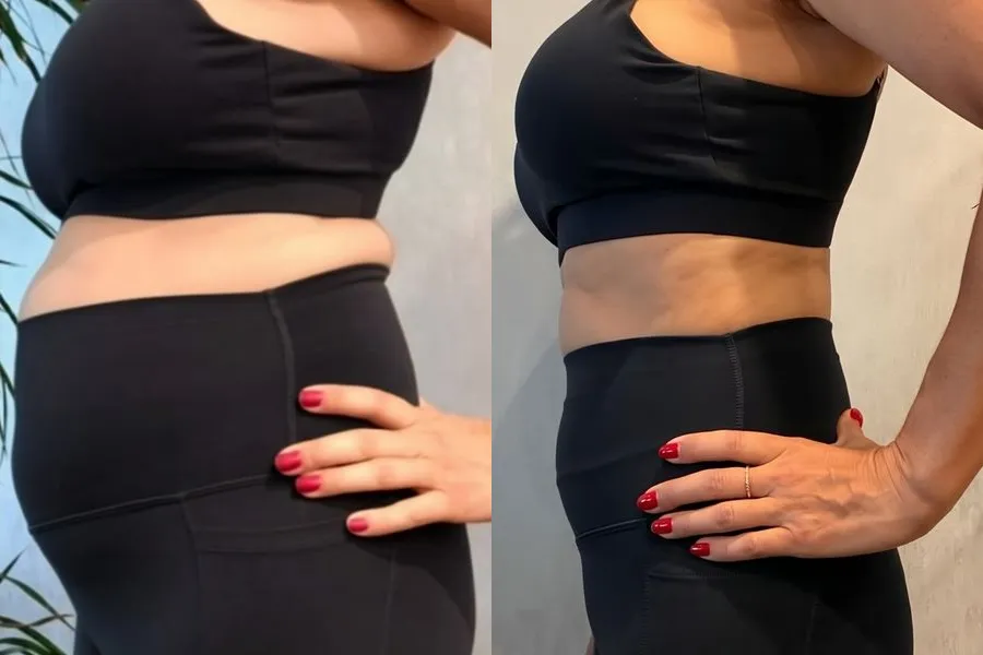 Antes e depois de paciente no emagrecimento com acompanhamento médico da Dra. Isabela Bertoglio, caso 5