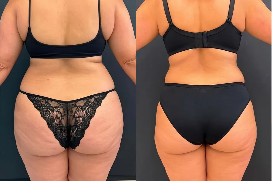 Antes e depois de paciente no emagrecimento com acompanhamento médico da Dra. Isabela Bertoglio, caso 2