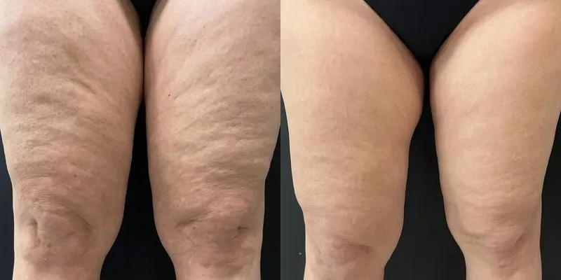 Antes e depois de tratamento com Unyque Pro: coxas, na Clínica Belvitá, em São Paulo